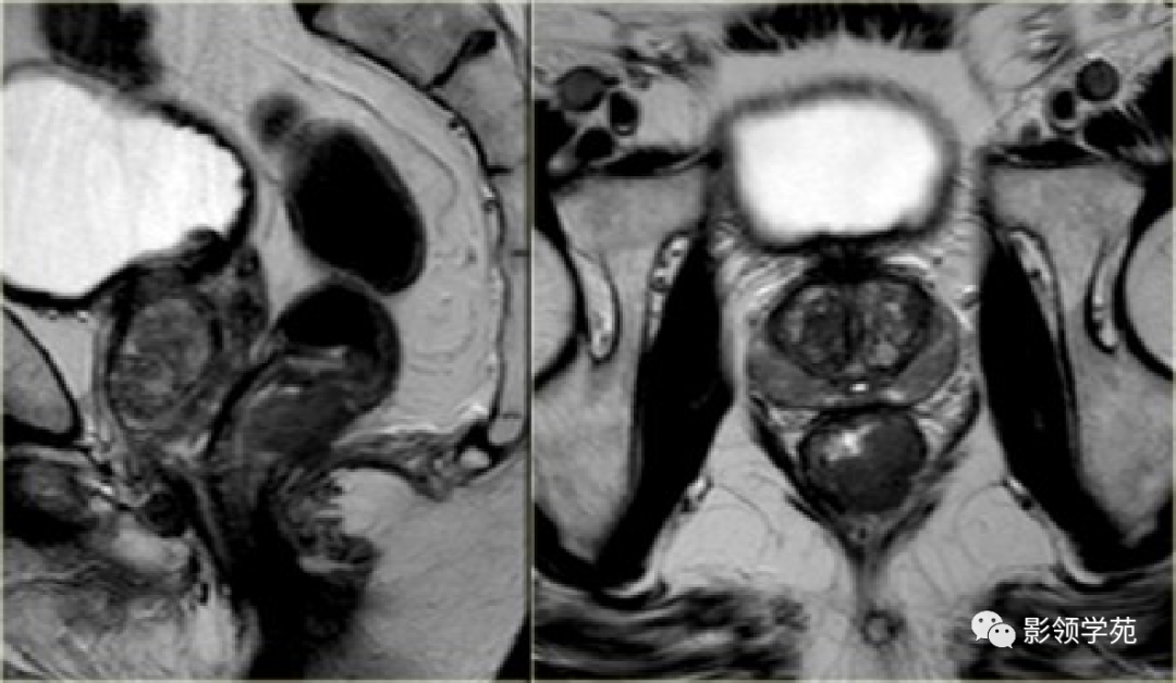 【图文详解】直肠癌MRI分期，你想知道的都在这里！