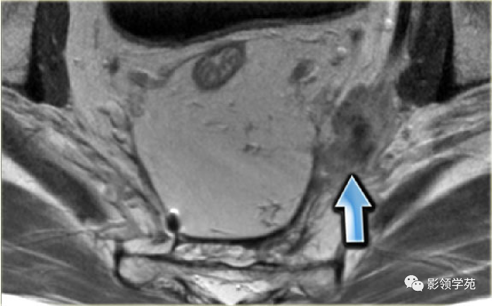 【图文详解】直肠癌MRI分期，你想知道的都在这里！