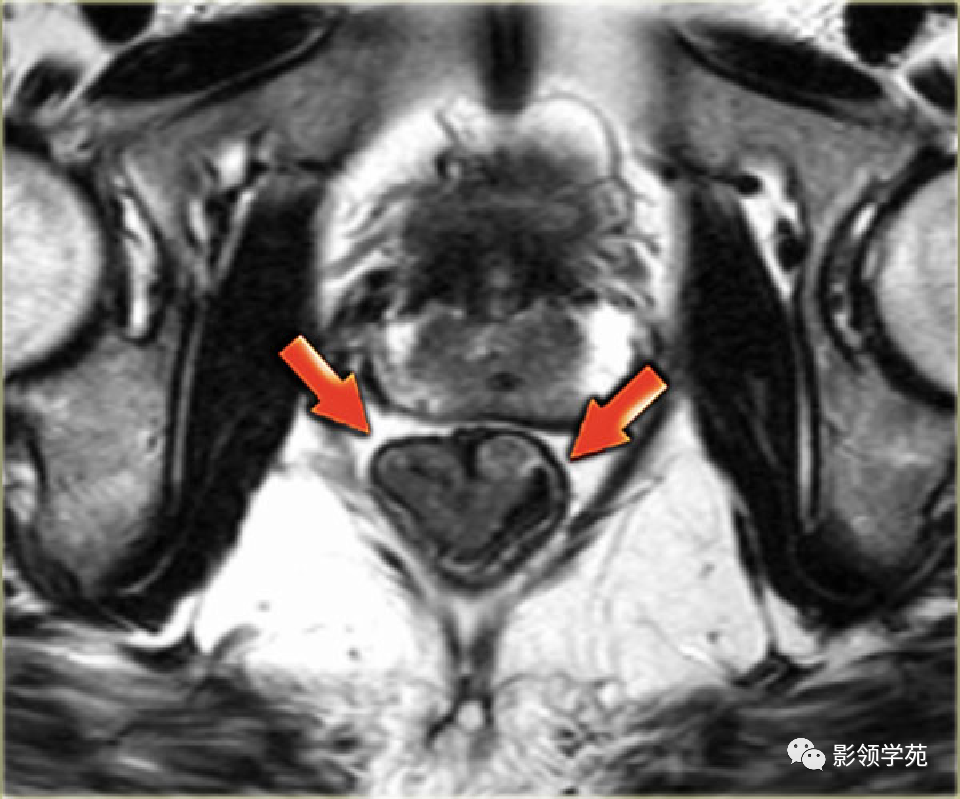 【图文详解】直肠癌MRI分期，你想知道的都在这里！