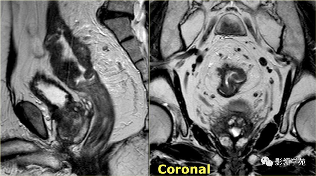 【图文详解】直肠癌MRI分期，你想知道的都在这里！