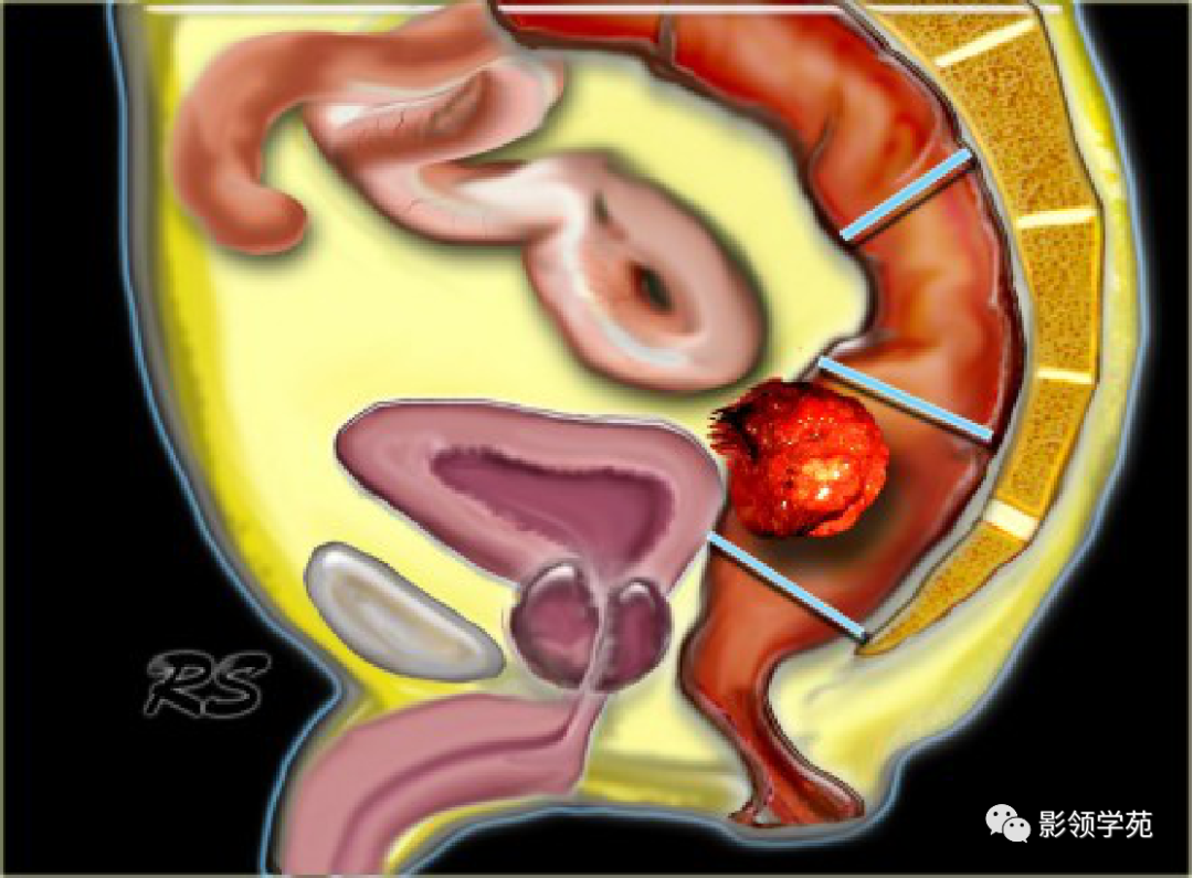 【图文详解】直肠癌MRI分期，你想知道的都在这里！