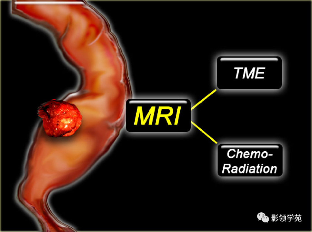【图文详解】直肠癌MRI分期，你想知道的都在这里！