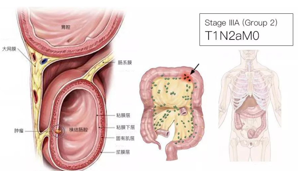 结直肠癌分期（含图谱），人人必会！