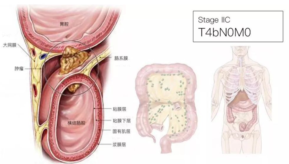 结直肠癌分期（含图谱），人人必会！