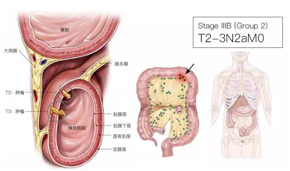 结直肠癌分期（含图谱），人人必会！