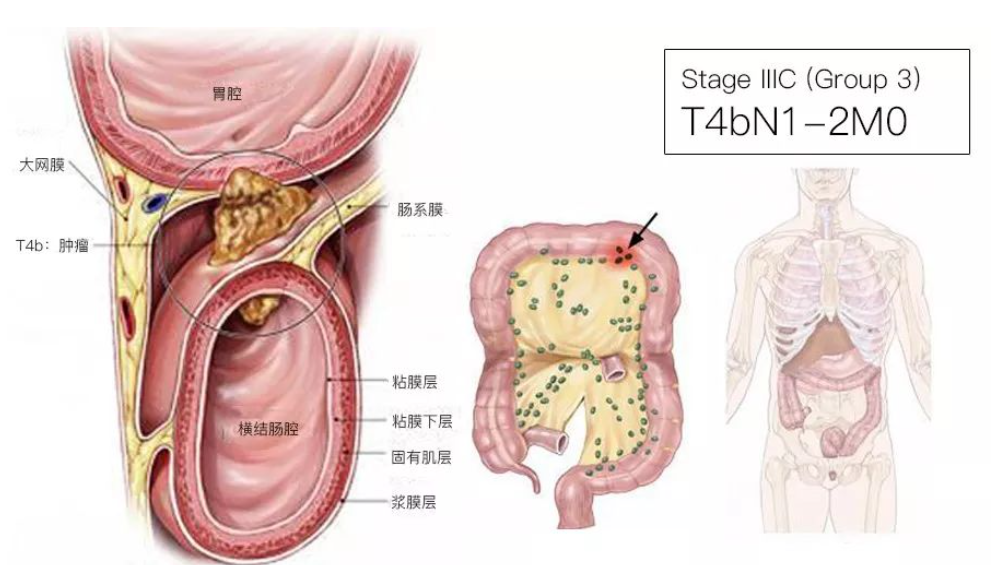 结直肠癌分期（含图谱），人人必会！