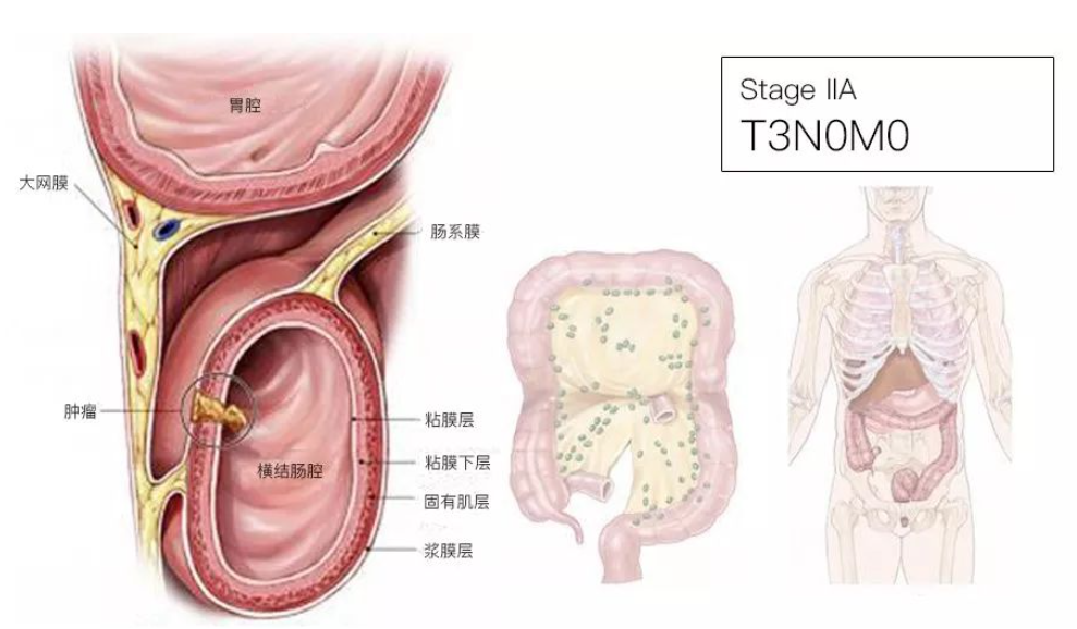 结直肠癌分期（含图谱），人人必会！