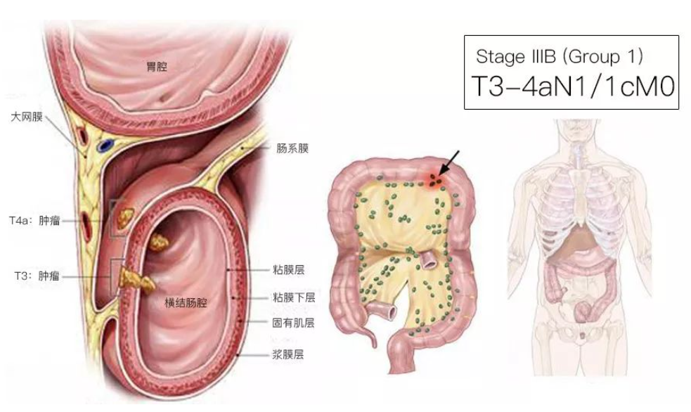 结直肠癌分期（含图谱），人人必会！