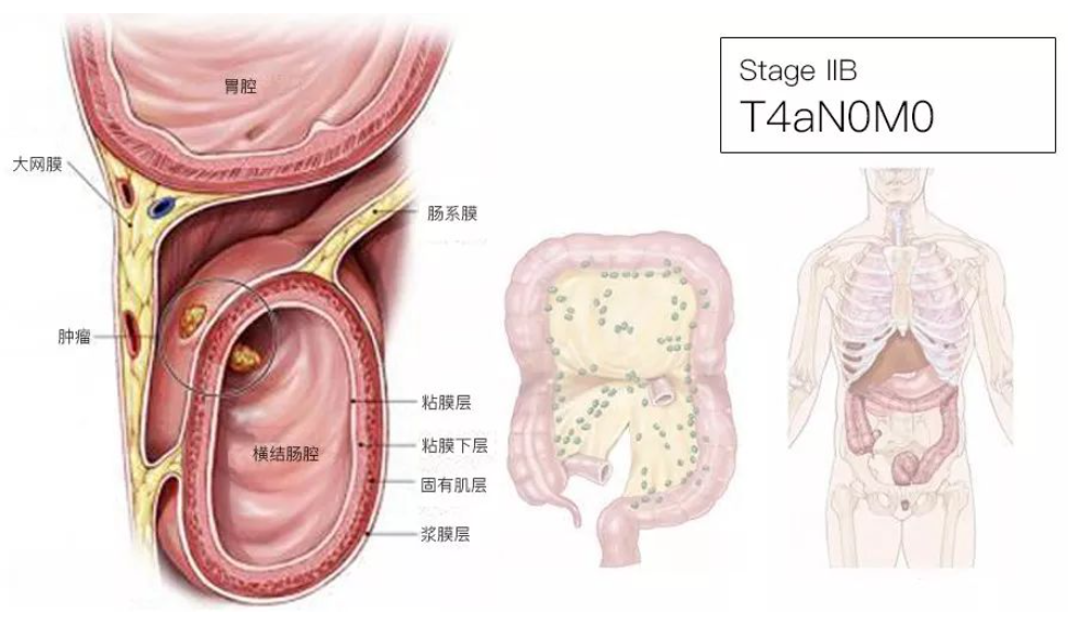 结直肠癌分期（含图谱），人人必会！