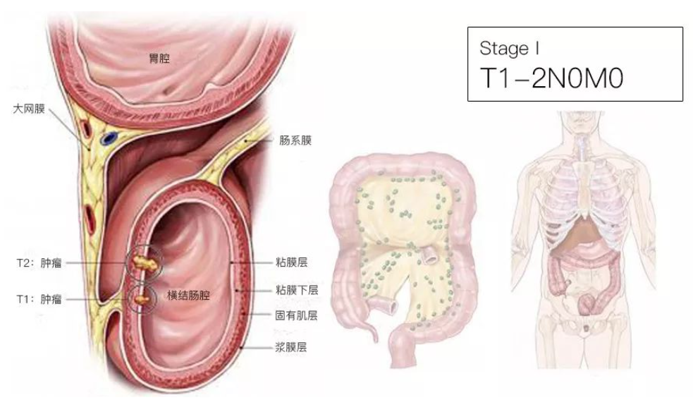 结直肠癌分期（含图谱），人人必会！