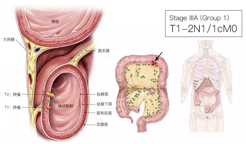 结直肠癌分期（含图谱），人人必会！