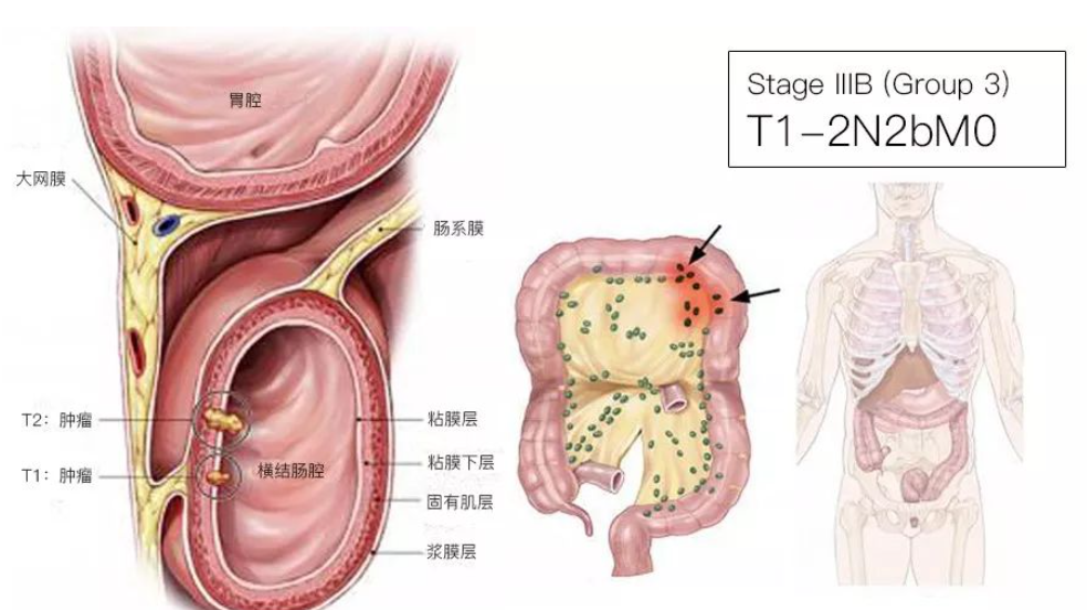 结直肠癌分期（含图谱），人人必会！