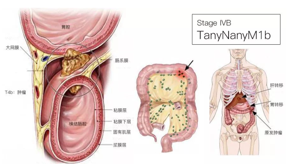结直肠癌分期（含图谱），人人必会！