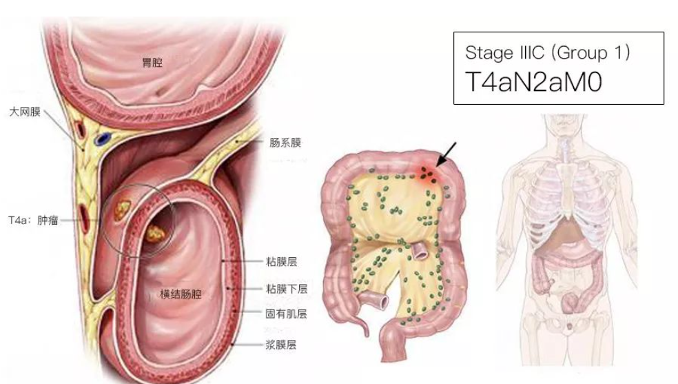 结直肠癌分期（含图谱），人人必会！
