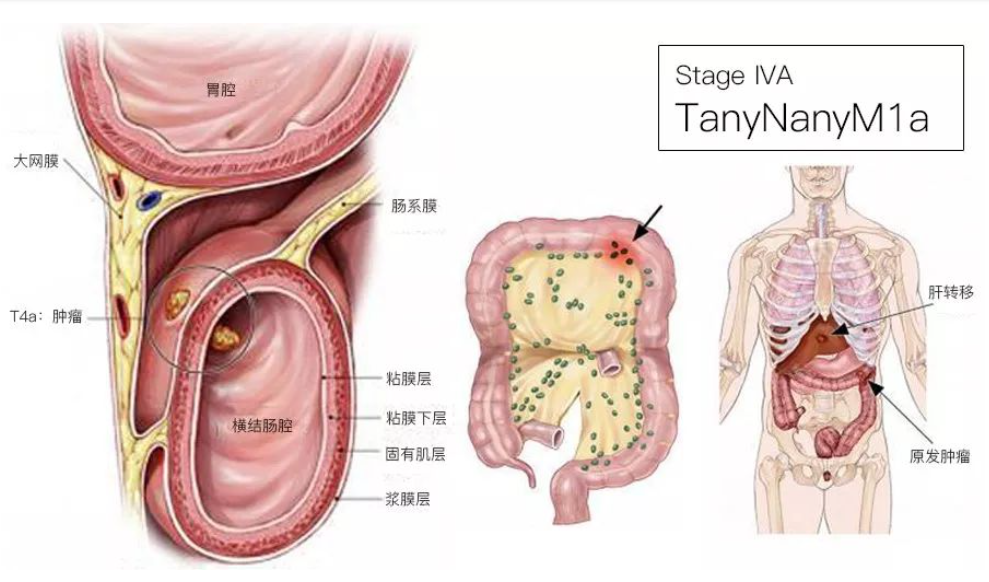 结直肠癌分期（含图谱），人人必会！