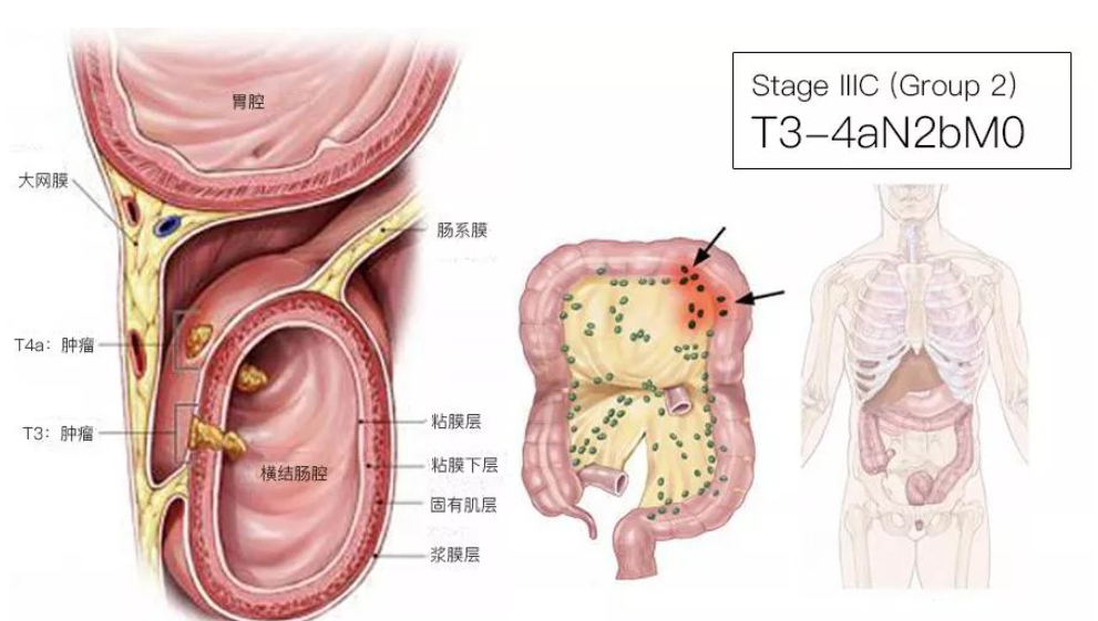 结直肠癌分期（含图谱），人人必会！