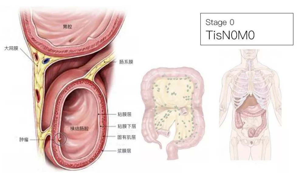 结直肠癌分期（含图谱），人人必会！