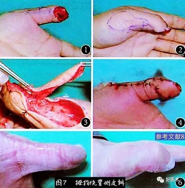 骨科急诊：常见指端损伤处理，详细步骤精讲！
