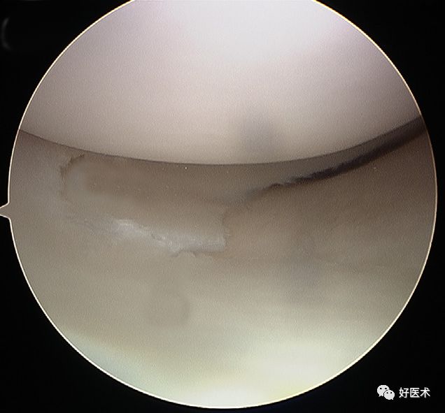 80张珍藏版超清动图，全面掌握半月板损伤MRI诊断！