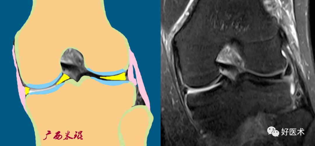 80张珍藏版超清动图，全面掌握半月板损伤MRI诊断！