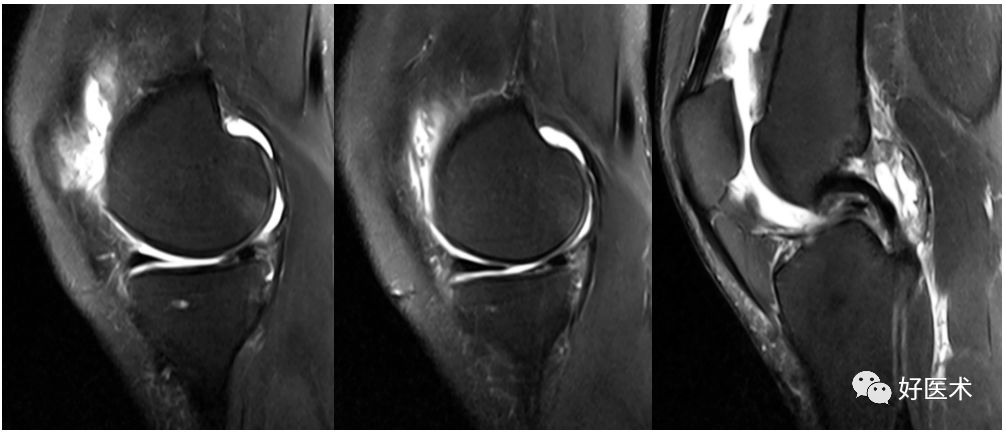 80张珍藏版超清动图，全面掌握半月板损伤MRI诊断！