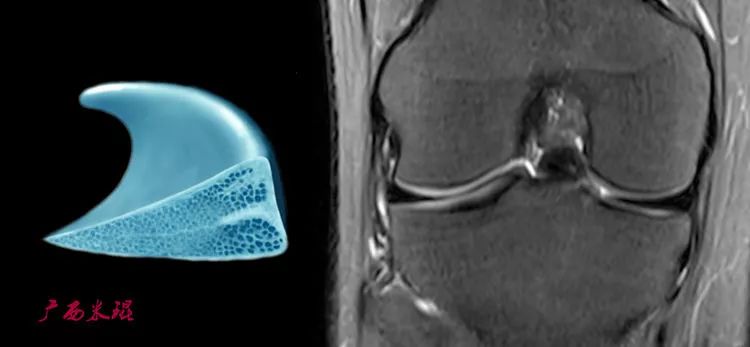 80张珍藏版超清动图，全面掌握半月板损伤MRI诊断！
