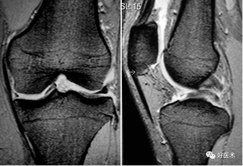 80张珍藏版超清动图，全面掌握半月板损伤MRI诊断！