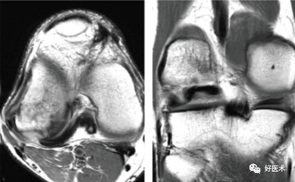 80张珍藏版超清动图，全面掌握半月板损伤MRI诊断！