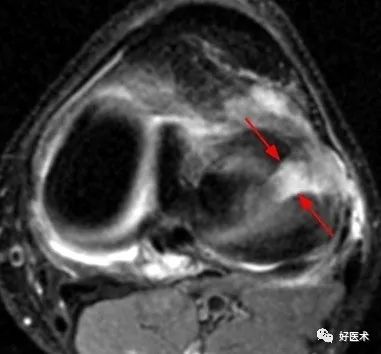 80张珍藏版超清动图，全面掌握半月板损伤MRI诊断！