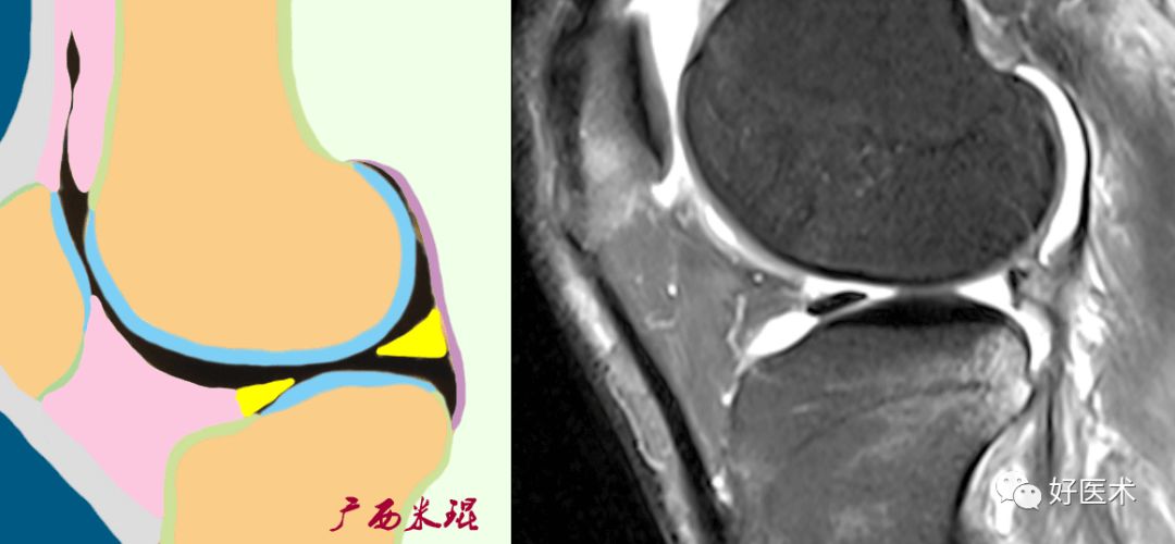 80张珍藏版超清动图，全面掌握半月板损伤MRI诊断！