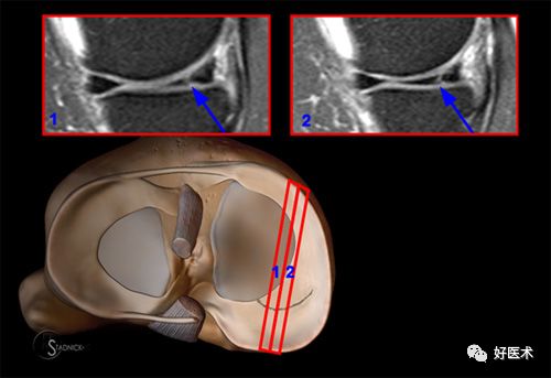80张珍藏版超清动图，全面掌握半月板损伤MRI诊断！