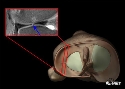 80张珍藏版超清动图，全面掌握半月板损伤MRI诊断！