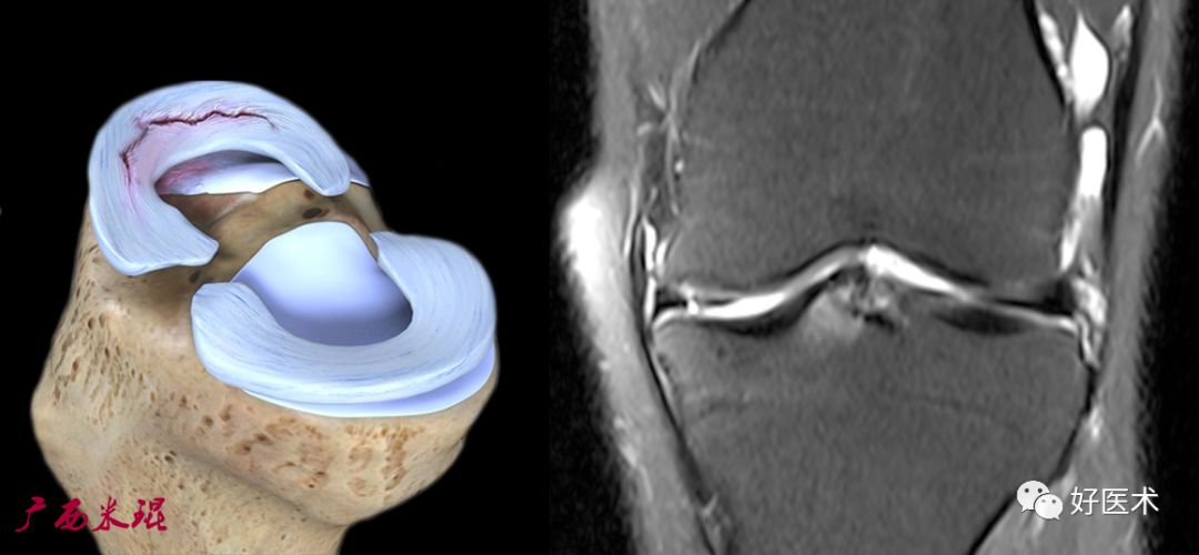 80张珍藏版超清动图，全面掌握半月板损伤MRI诊断！