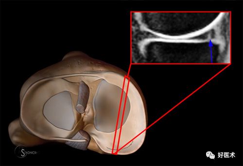 80张珍藏版超清动图，全面掌握半月板损伤MRI诊断！
