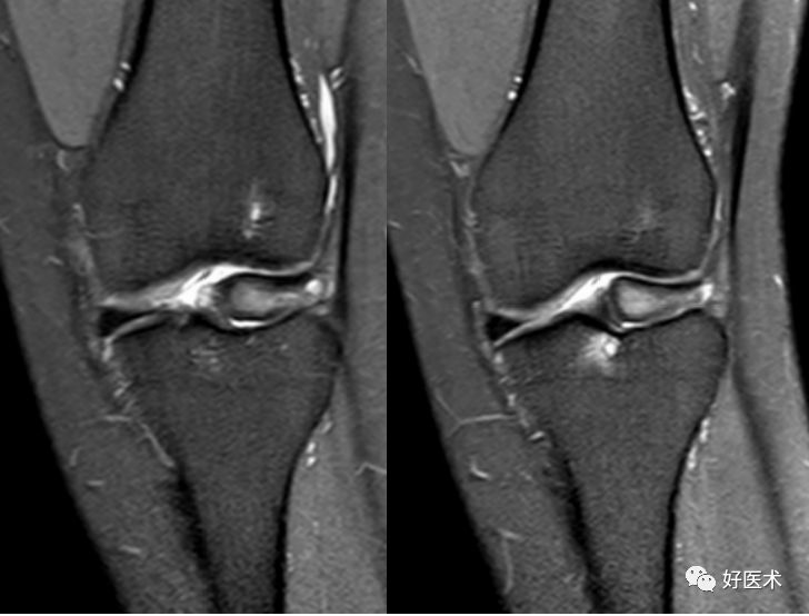 80张珍藏版超清动图，全面掌握半月板损伤MRI诊断！
