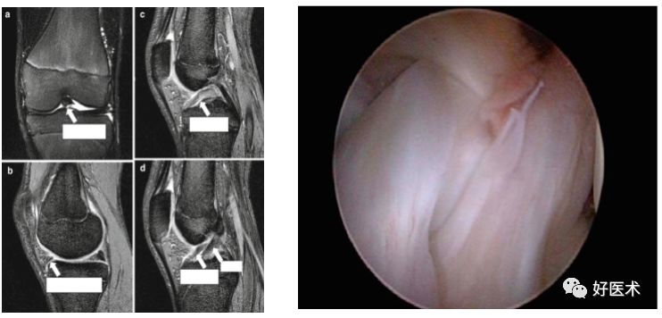 80张珍藏版超清动图，全面掌握半月板损伤MRI诊断！