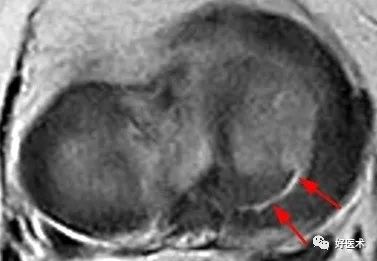 80张珍藏版超清动图，全面掌握半月板损伤MRI诊断！