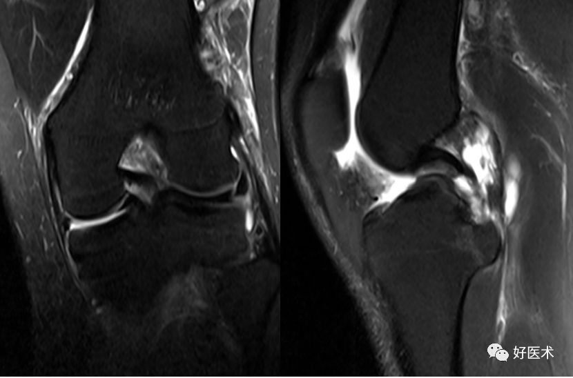 80张珍藏版超清动图，全面掌握半月板损伤MRI诊断！