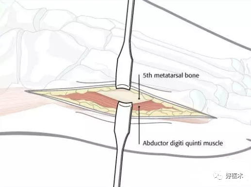 第五跖骨基底部骨折：内固定选择及手术入路详解！