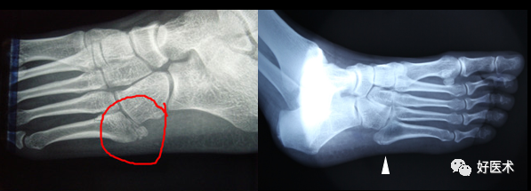 第五跖骨基底部骨折：内固定选择及手术入路详解！