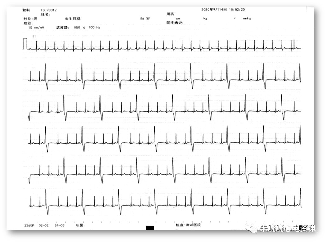 全面解读心电图报告，不再懵懵懂懂！