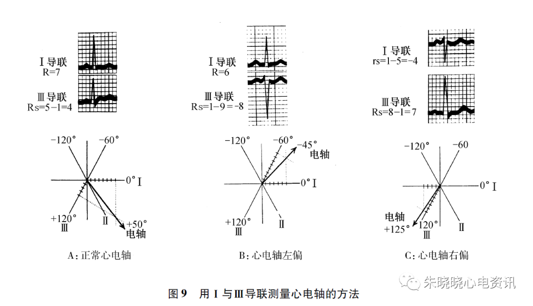 全面解读心电图报告，不再懵懵懂懂！