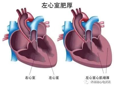 全面解读心电图报告，不再懵懵懂懂！