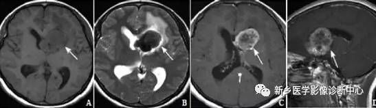 常见但不简单，这15种脑膜瘤你能诊断吗？