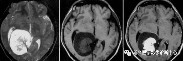常见但不简单，这15种脑膜瘤你能诊断吗？