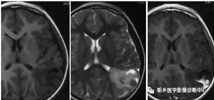 常见但不简单，这15种脑膜瘤你能诊断吗？