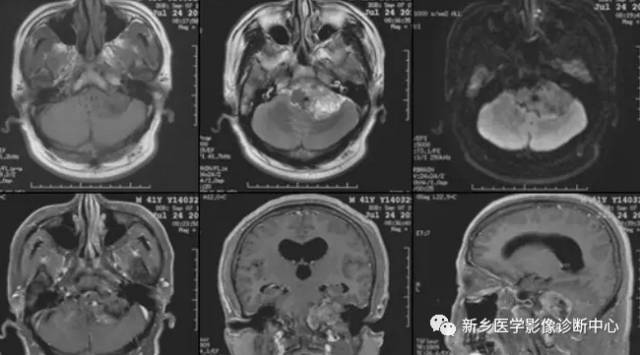 常见但不简单，这15种脑膜瘤你能诊断吗？