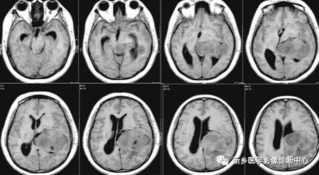 常见但不简单，这15种脑膜瘤你能诊断吗？