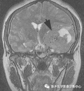 常见但不简单，这15种脑膜瘤你能诊断吗？