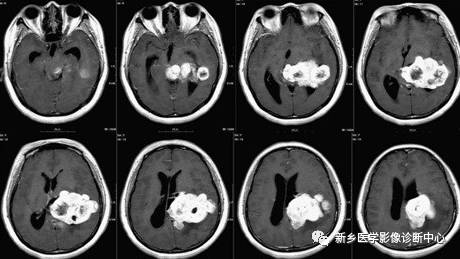 常见但不简单，这15种脑膜瘤你能诊断吗？